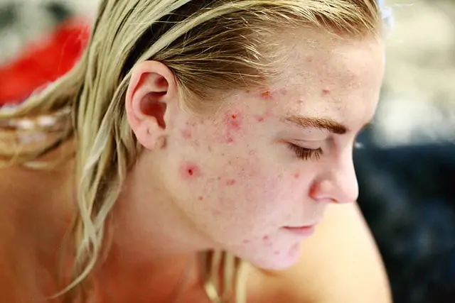 Acne Vulgar X olho seco: existe relação?