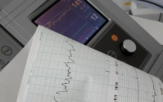 Impacto da fibrilação atrial em pacientes com insuficiência cardíaca